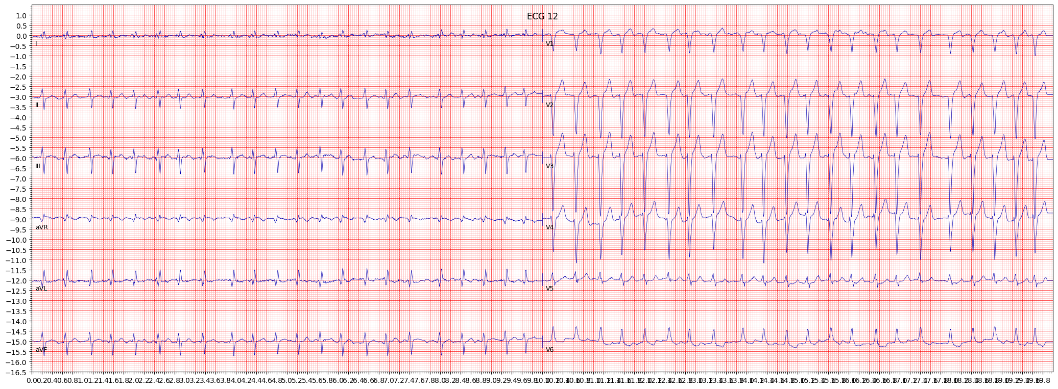 ECG example image