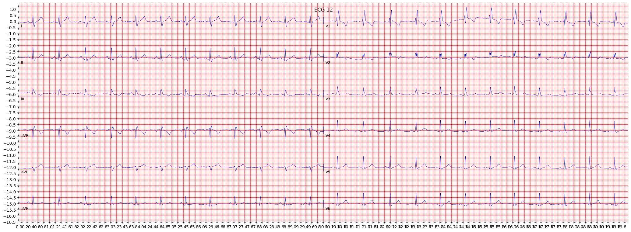 complete right bundle branch block (CRBBB) example 1024