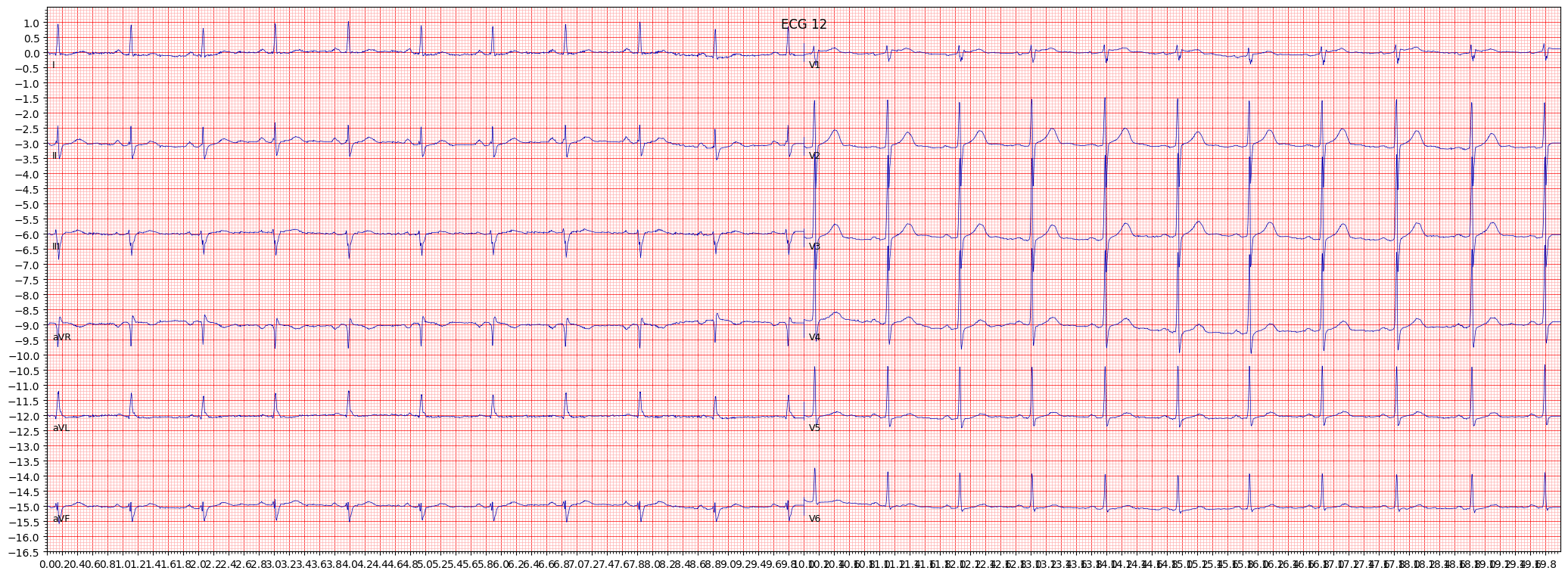 non-specifc intraventricular conduction disturbance (block) (IVCD) example 1064