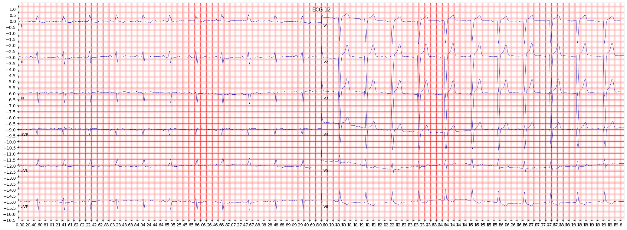complete left bundle branch block (CLBBB) example 1072