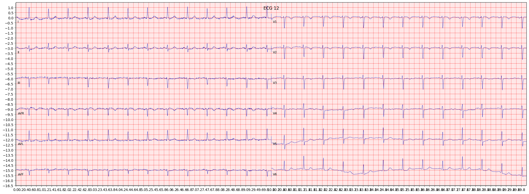 ischemic in anteroseptal leads (ISCAS) example 11030