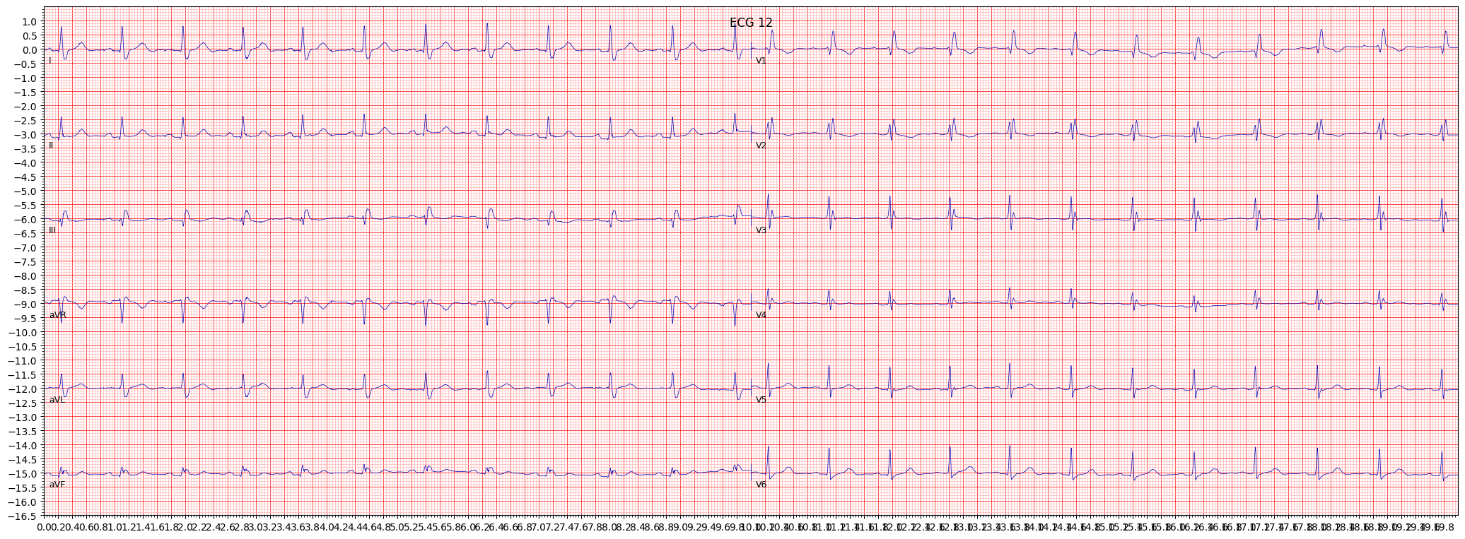 complete right bundle branch block (CRBBB) example 1123