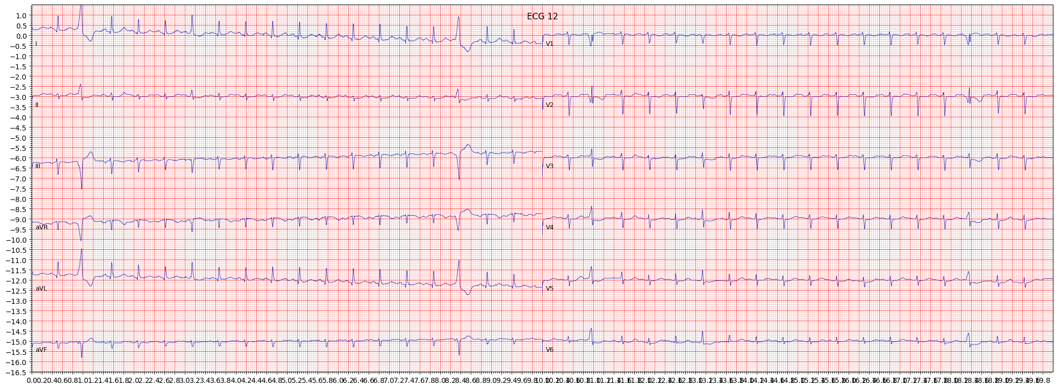 ischemic in lateral leads (ISCLA) example 11251