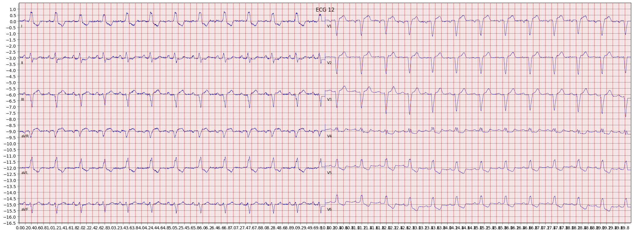 complete left bundle branch block (CLBBB) example 1156
