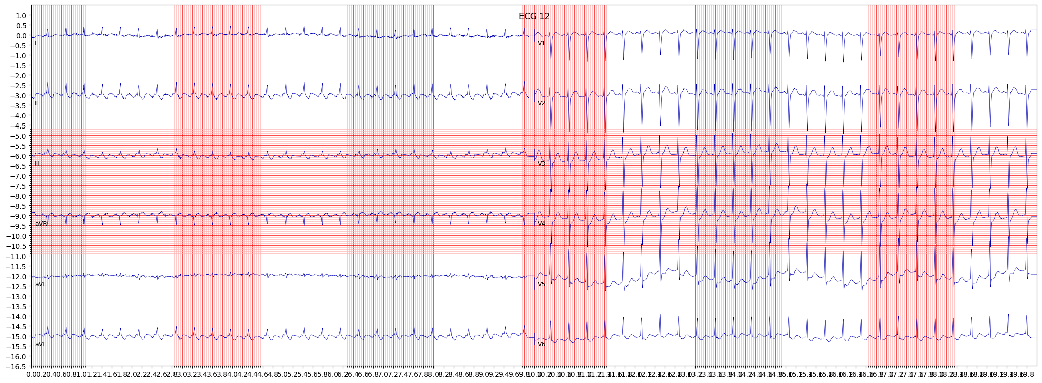 atrial futter (AFLT) example 1173