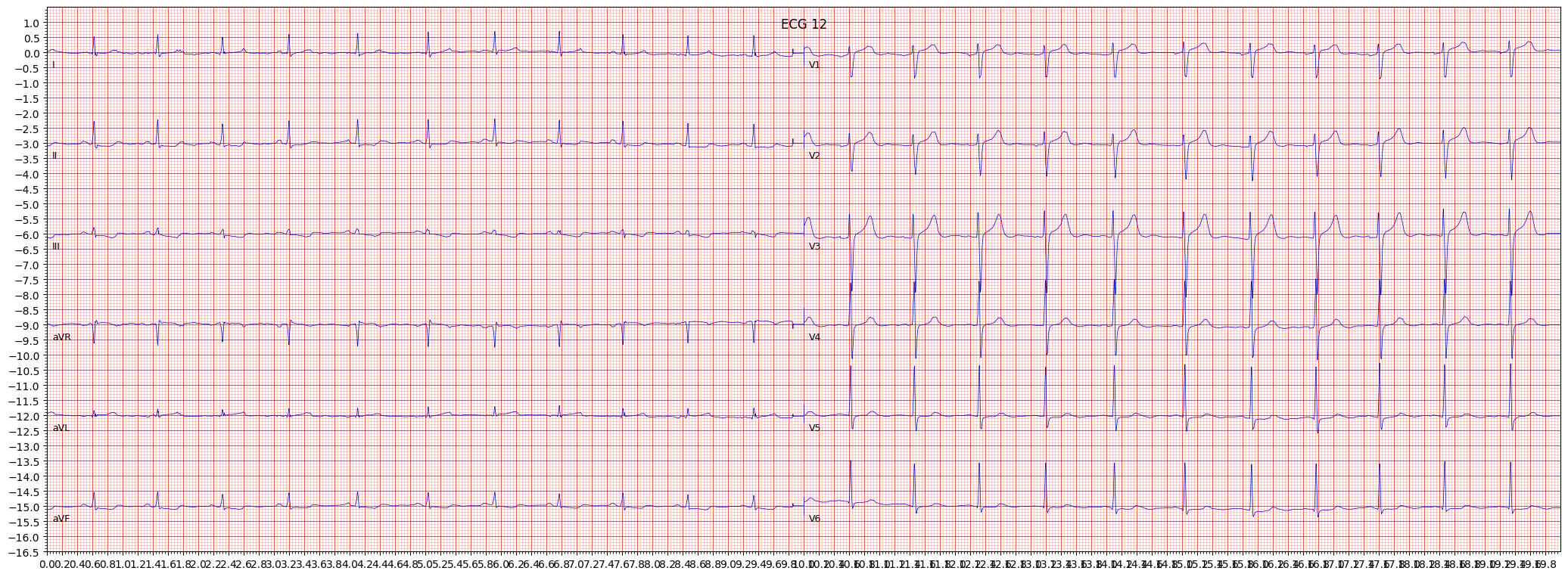 ischemic in inferior leads (ISCIN) example 1175