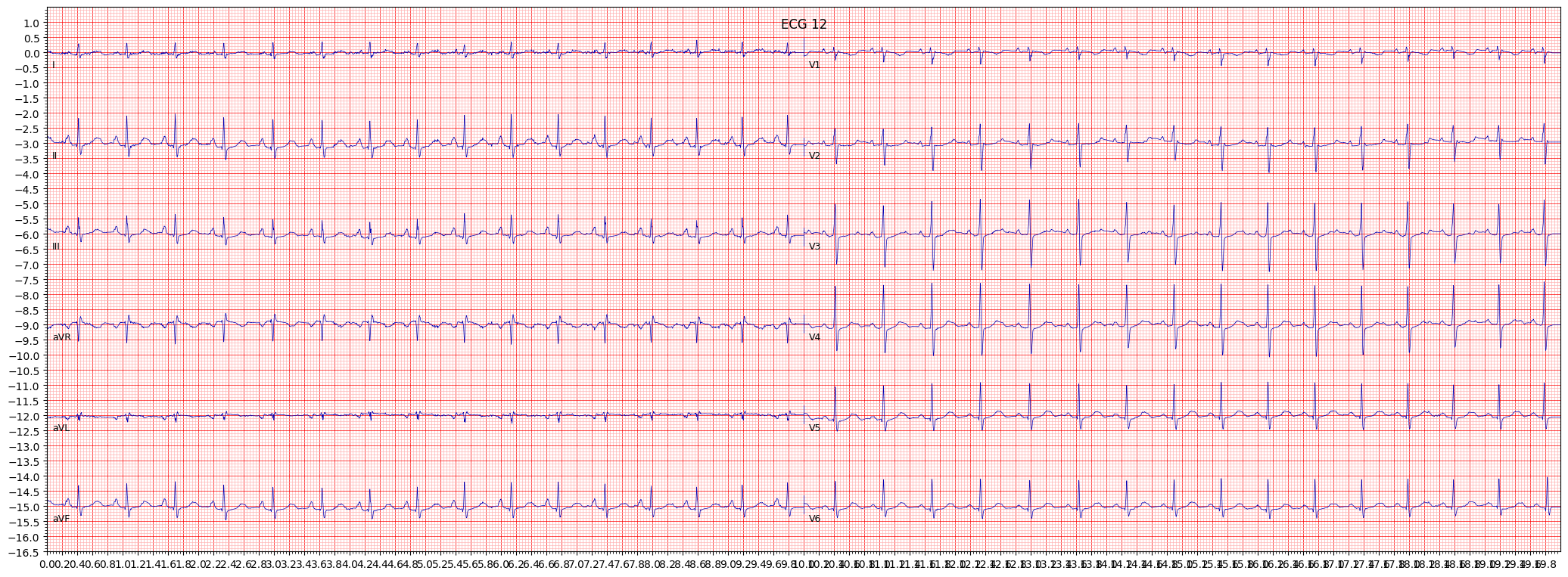 long QT-interval (LNGQT) example 11916