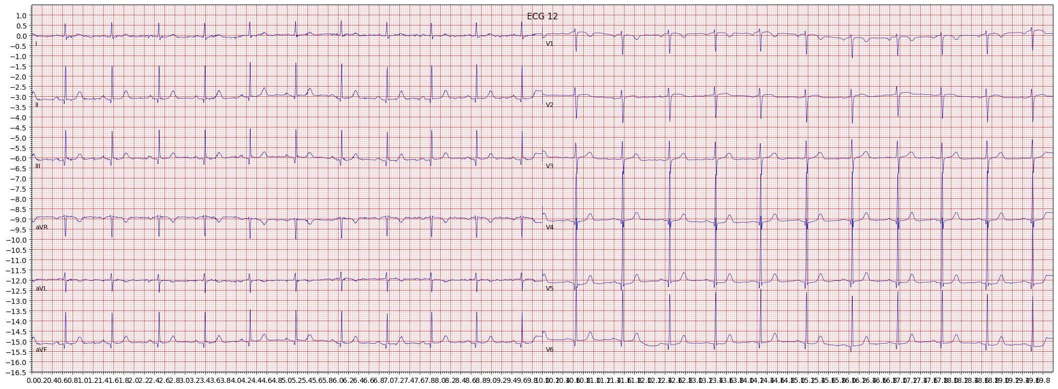 left ventricular hypertrophy (LVH) example 1198
