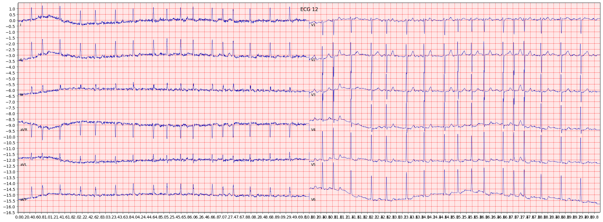 ischemic in lateral leads (ISCLA) example 12047