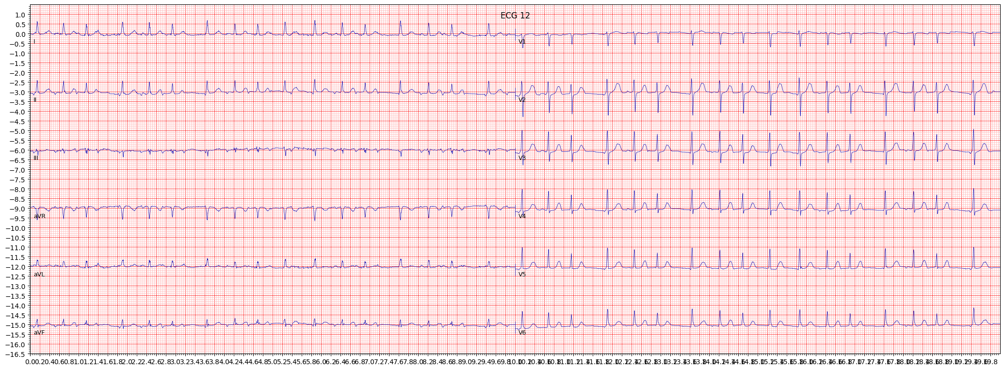 atrial fbrillation (AFIB) example 12632