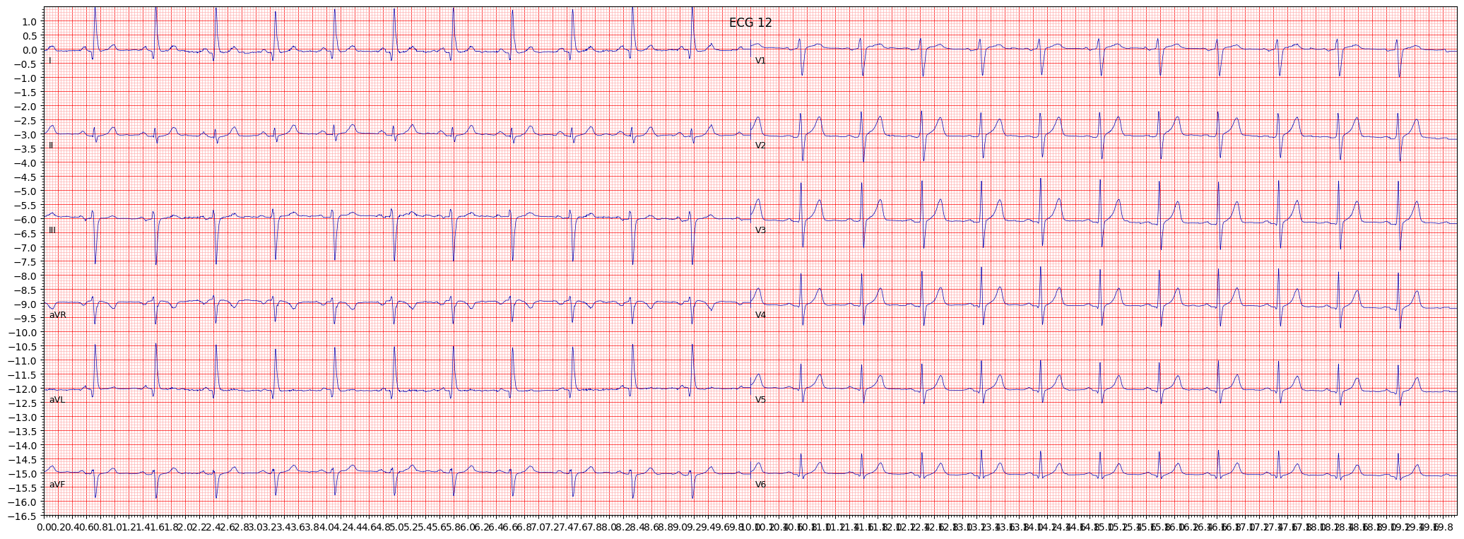 non-specifc intraventricular conduction disturbance (block) (IVCD) example 1284