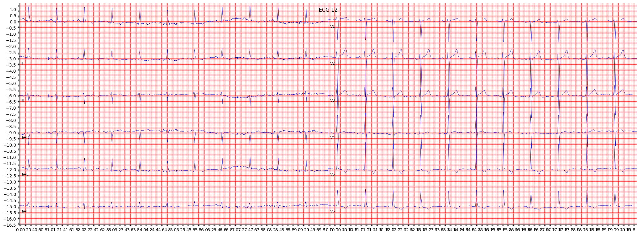 left ventricular hypertrophy (LVH) example 1370
