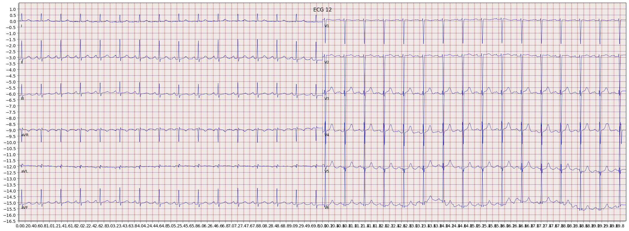 left ventricular hypertrophy (LVH) example 138