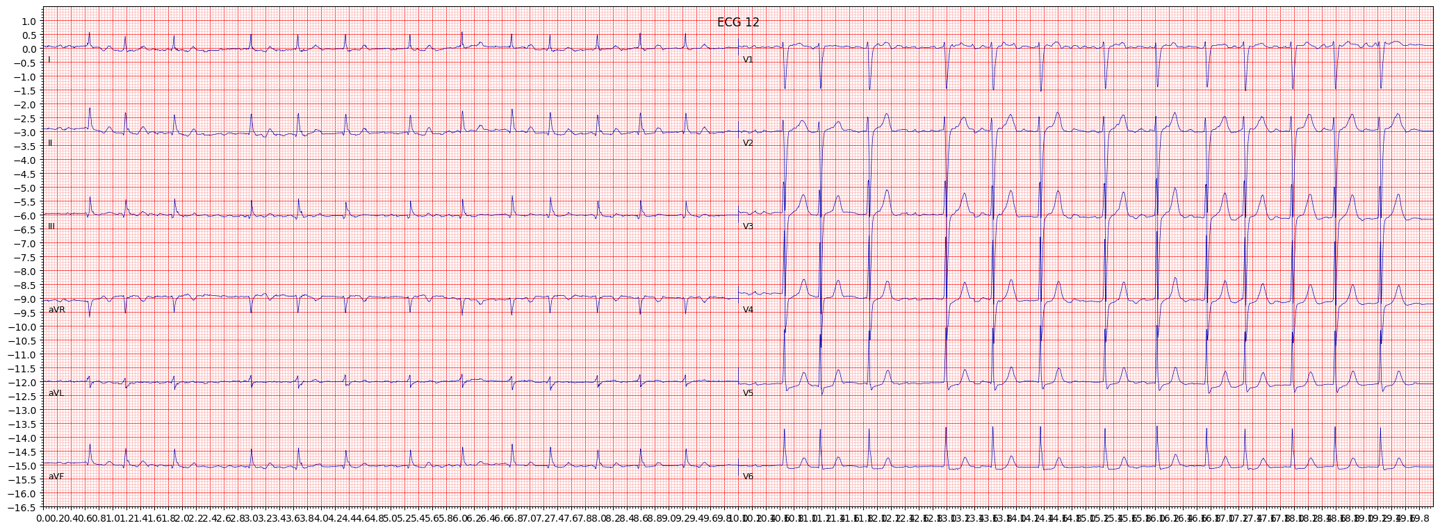 atrial fbrillation (AFIB) example 13832