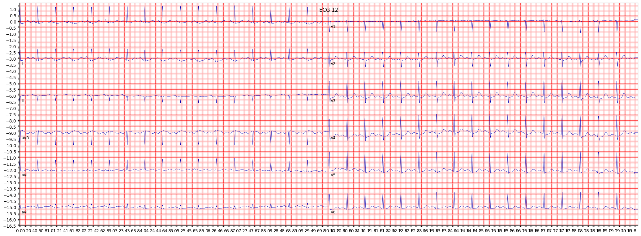 long QT-interval (LNGQT) example 13838