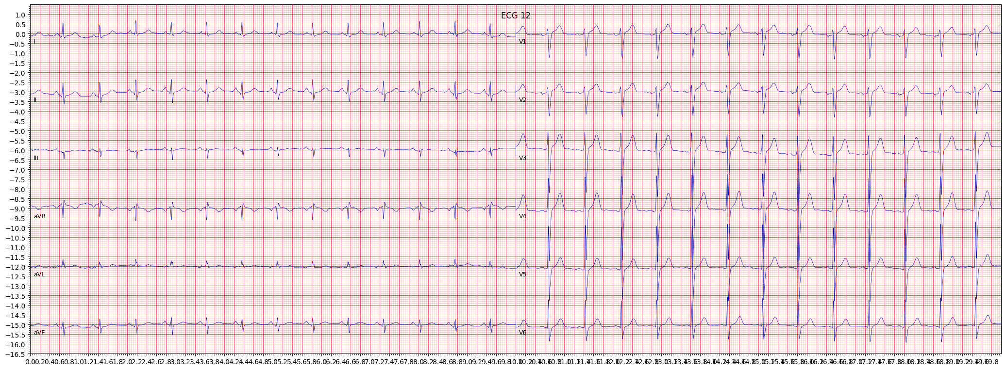 non-specifc intraventricular conduction disturbance (block) (IVCD) example 1398