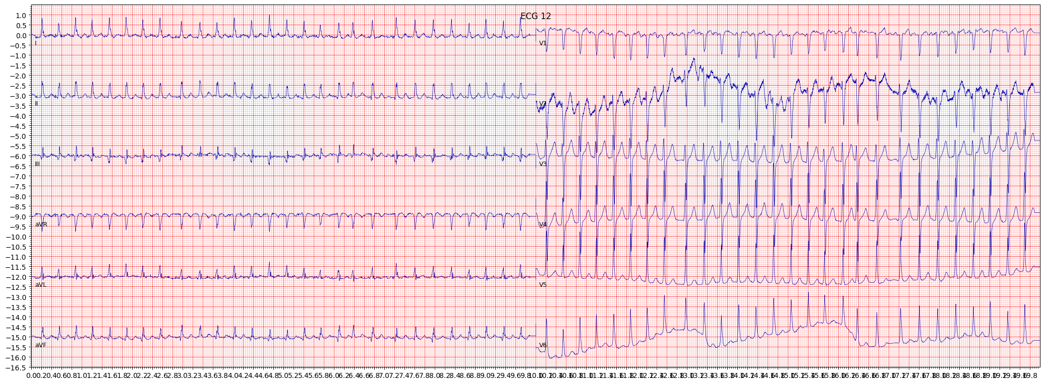 atrial fbrillation (AFIB) example 14102