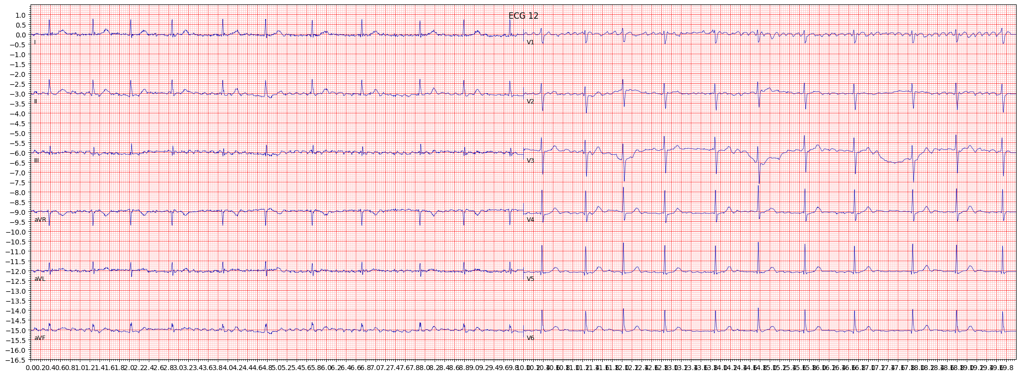 atrial fbrillation (AFIB) example 14221