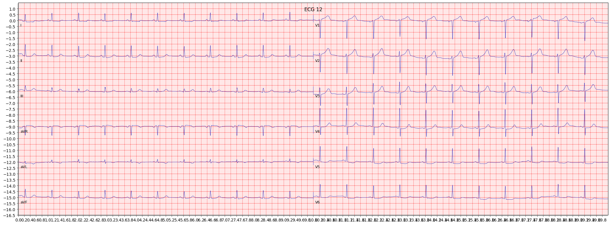 ischemic in anterolateral leads (ISCAL) example 1429