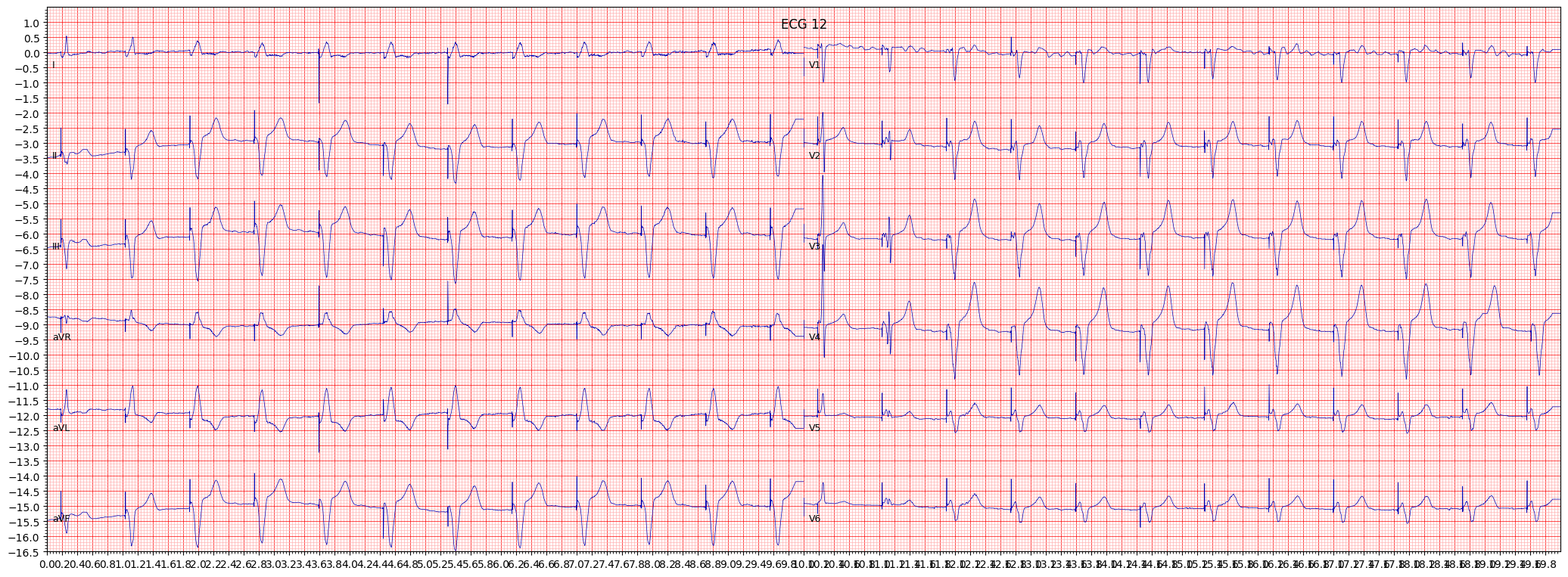 normal functioning artifcial pacemaker (PACE) example 144