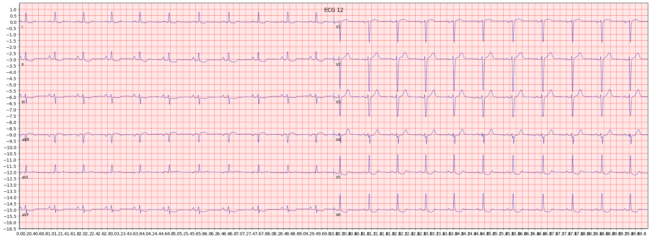 ischemic in inferolateral leads (ISCIL) example 1445