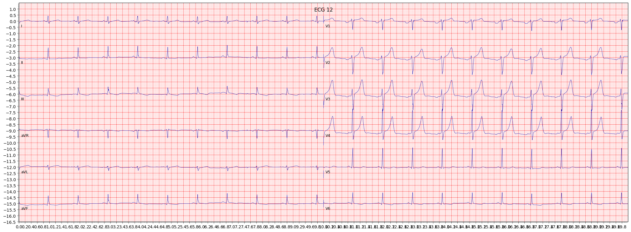 ischemic in inferolateral leads (ISCIL) example 1449
