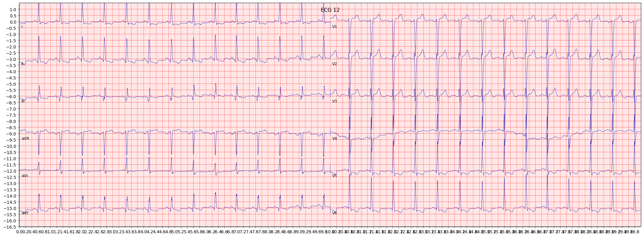 left ventricular hypertrophy (LVH) example 1451
