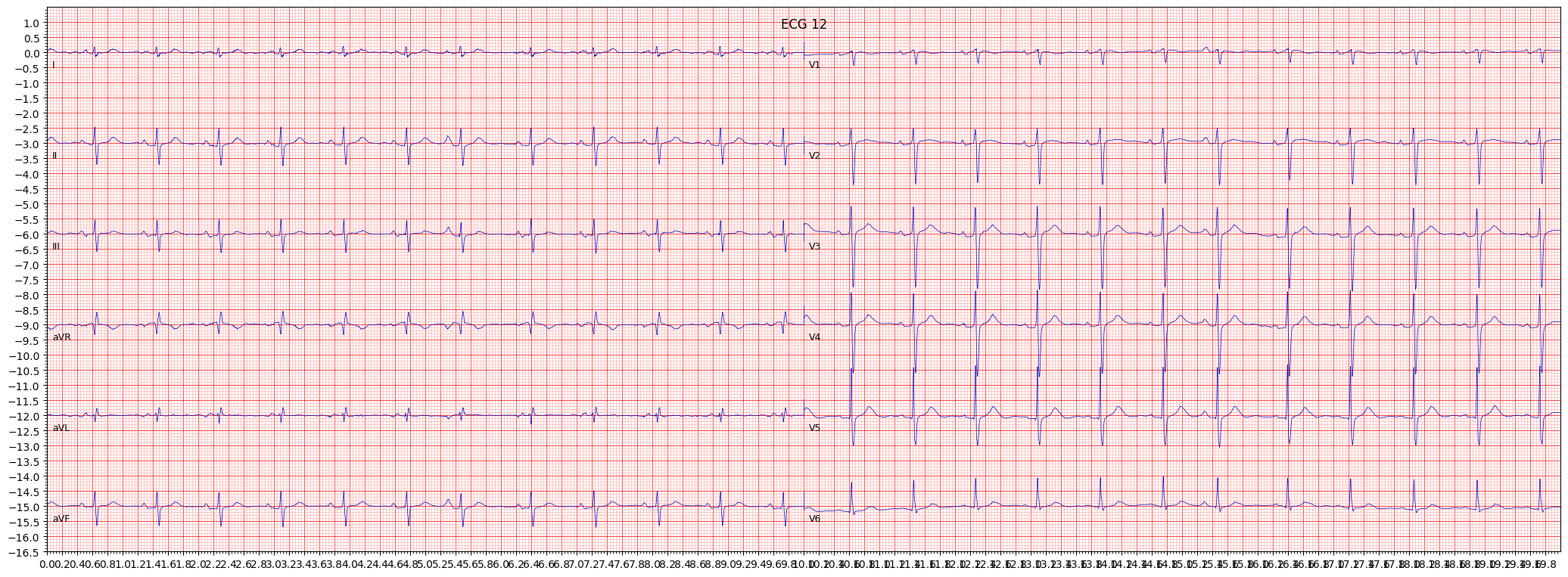 non-diagnostic T abnormalities (NDT) example 148