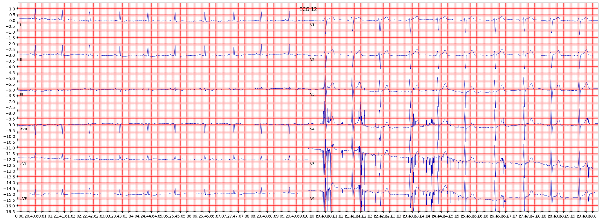 ischemic in inferior leads (ISCIN) example 14999