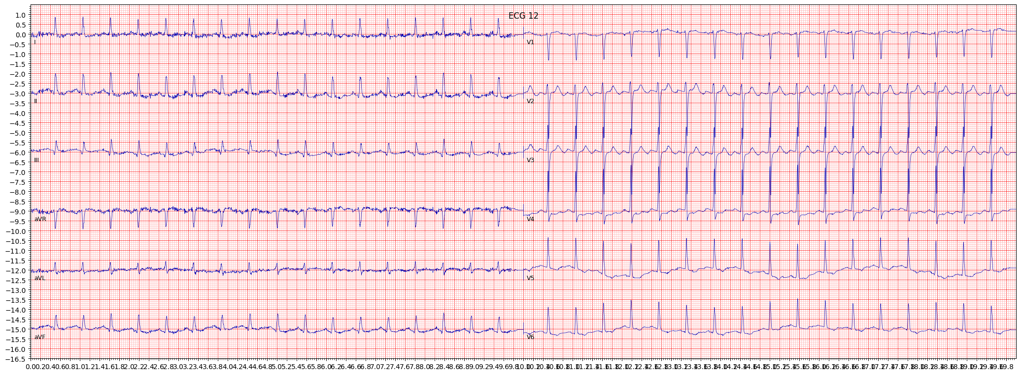 ischemic in lateral leads (ISCLA) example 1520