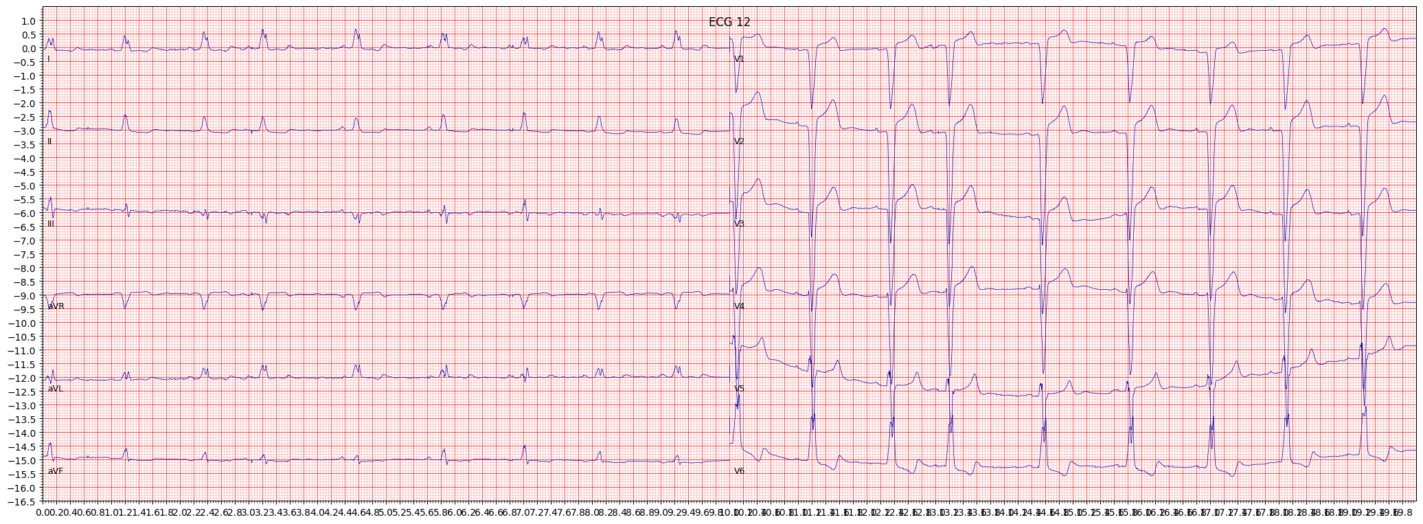 complete left bundle branch block (CLBBB) example 1564