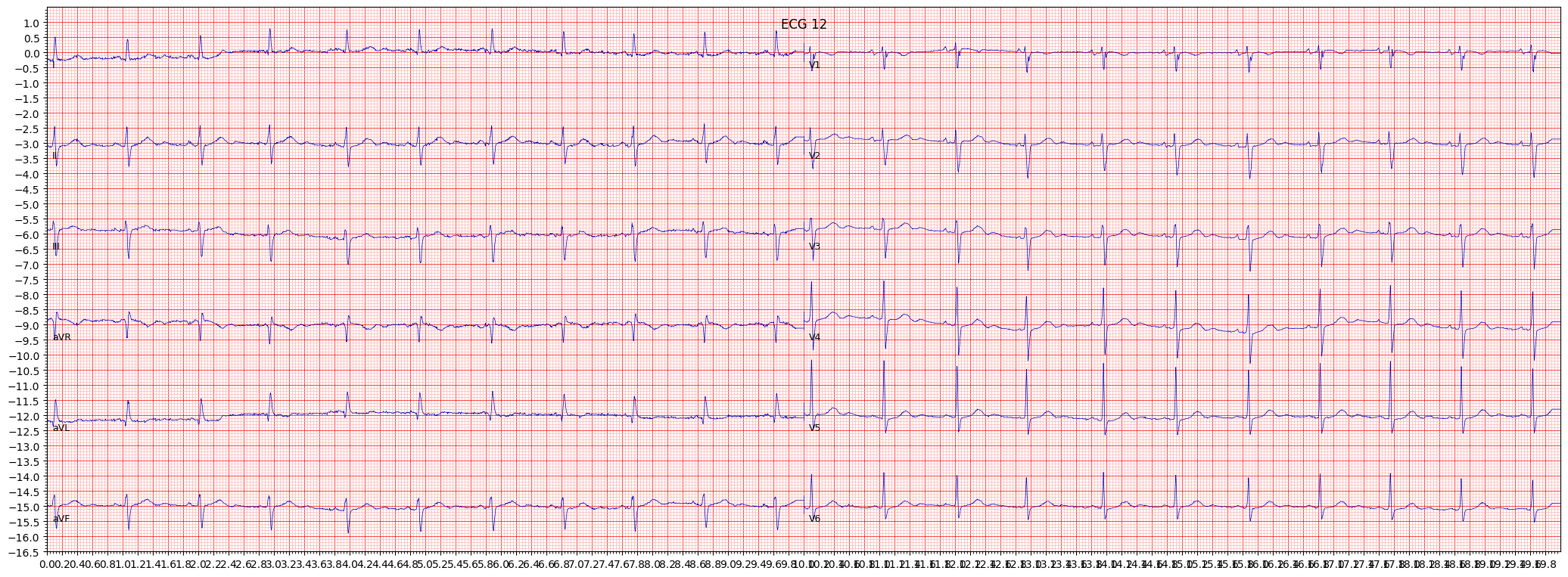 left anterior fascicular block (LAFB) example 157