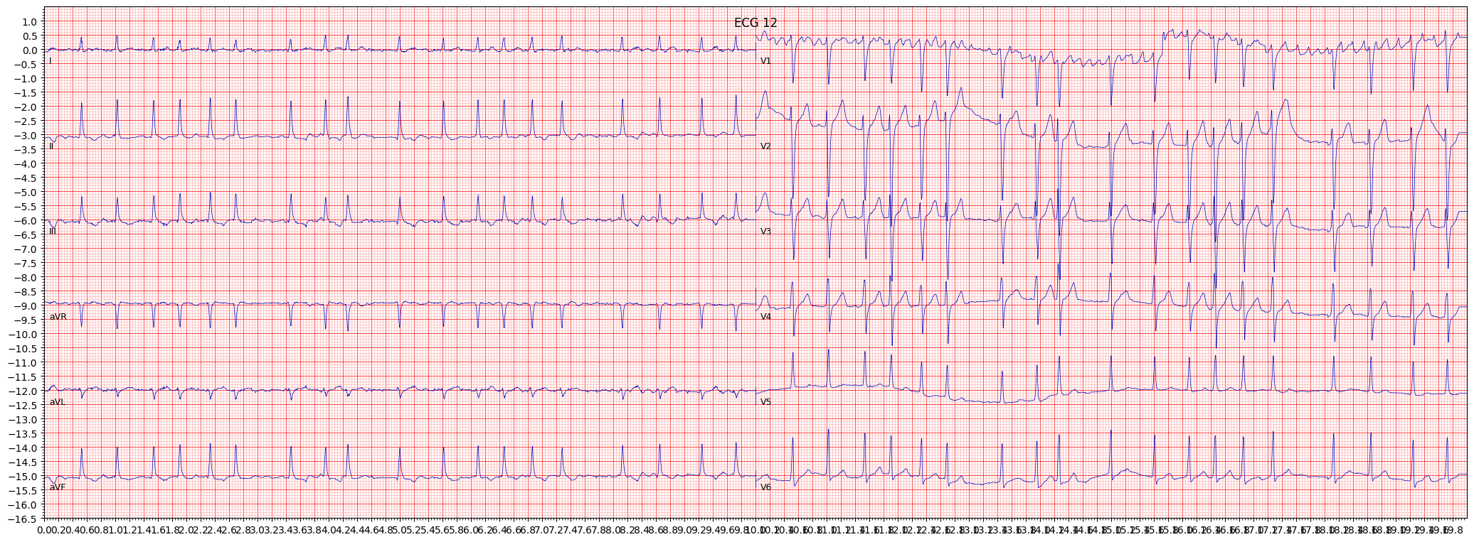 ischemic in inferior leads (ISCIN) example 15781