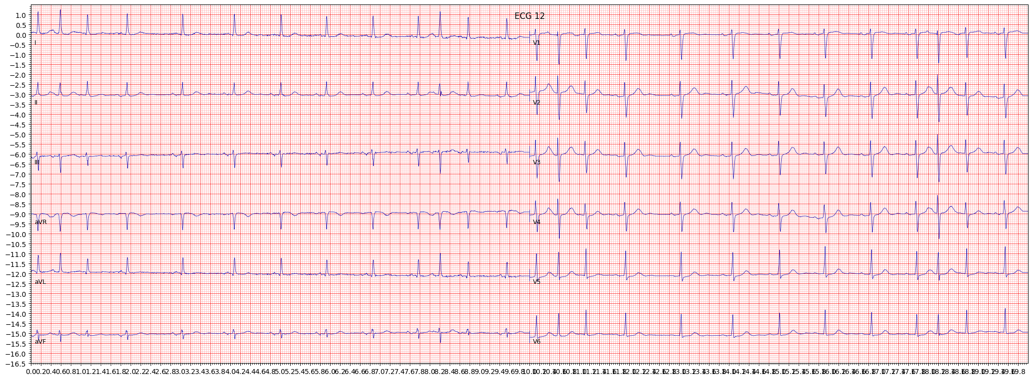 atrial fbrillation (AFIB) example 15834