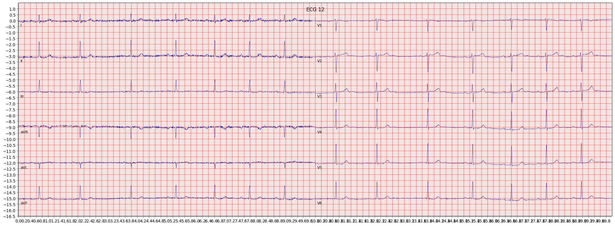 normal functioning artifcial pacemaker (PACE) example 1596