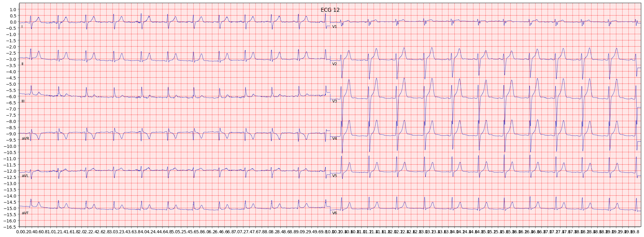 left posterior fascicular block (LPFB) example 16116