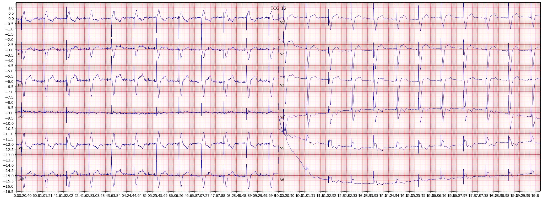normal functioning artifcial pacemaker (PACE) example 1641