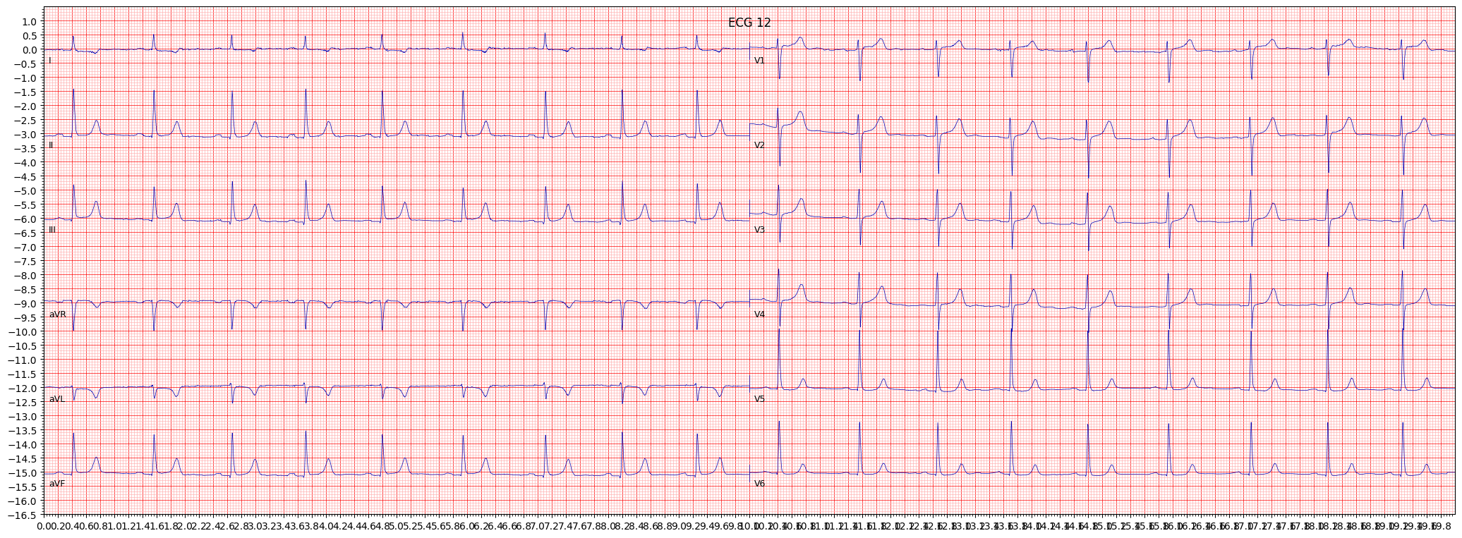ischemic in anterolateral leads (ISCAL) example 167