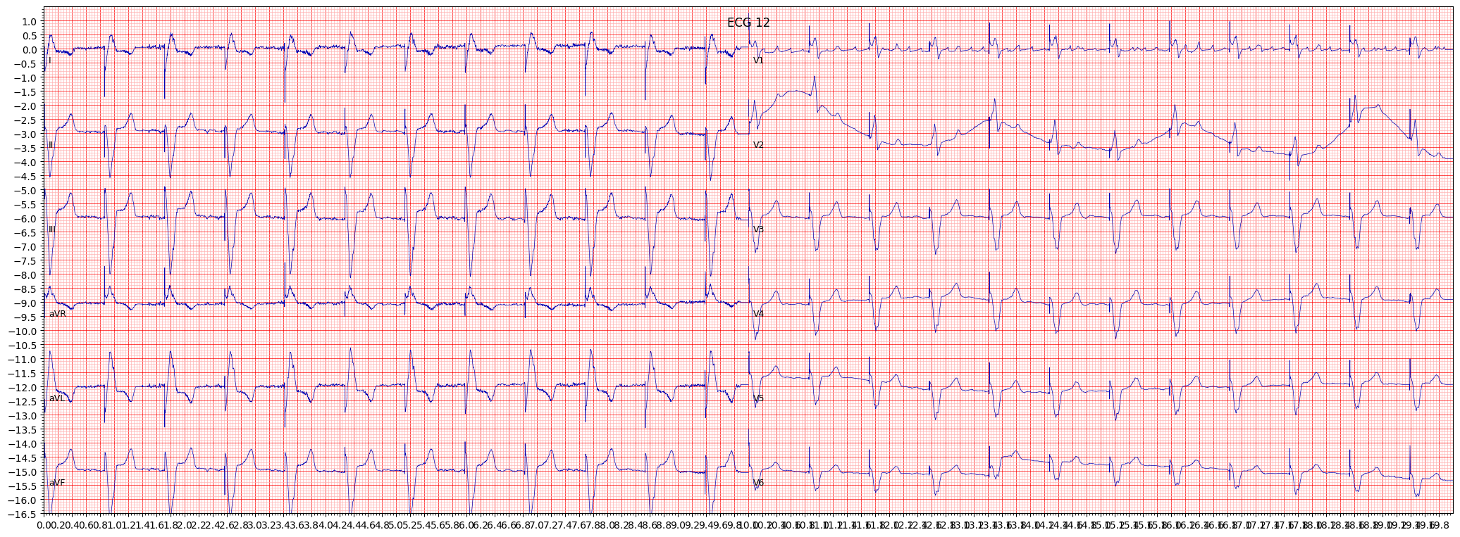 normal functioning artifcial pacemaker (PACE) example 1674