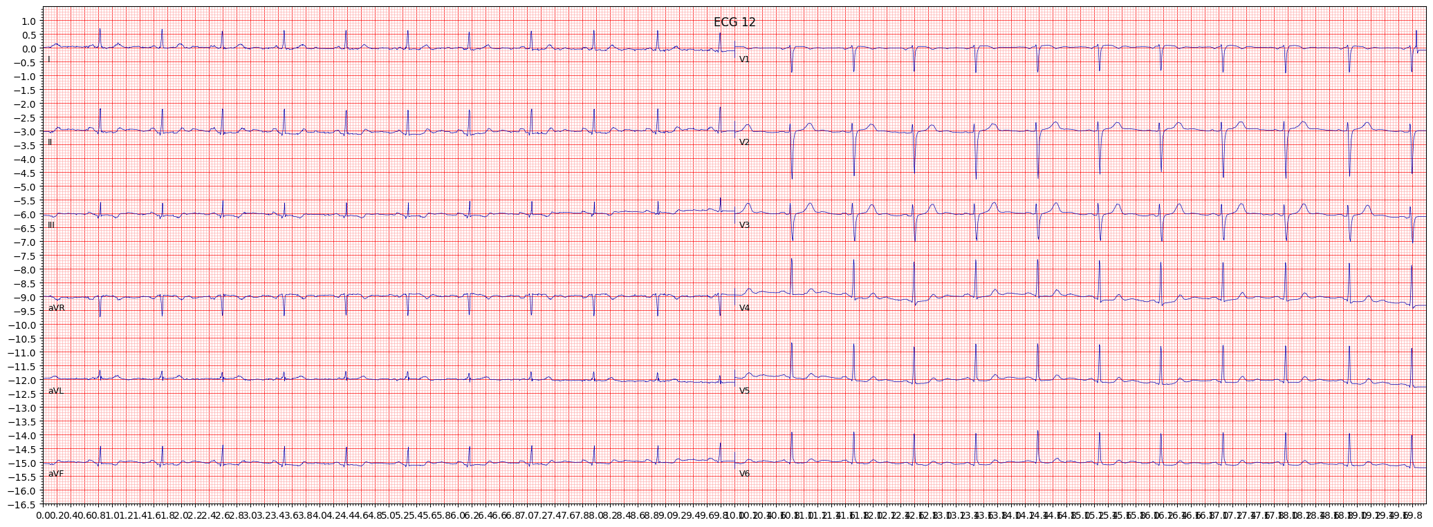 ischemic in inferior leads (ISCIN) example 16915