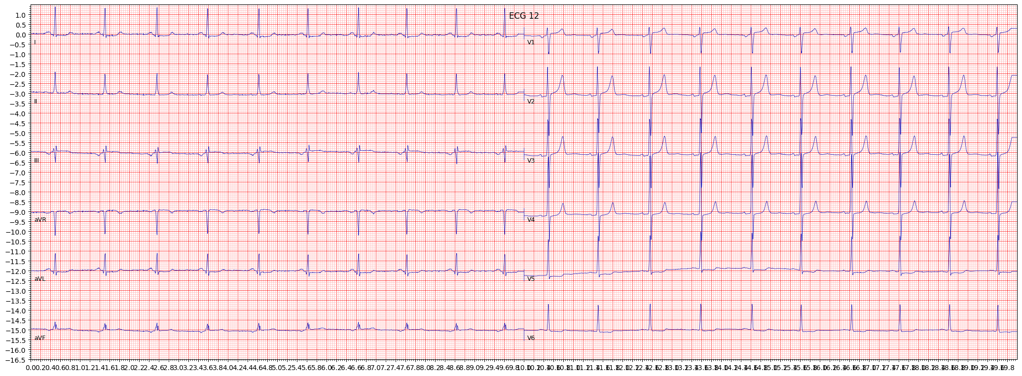 ischemic in inferolateral leads (ISCIL) example 171
