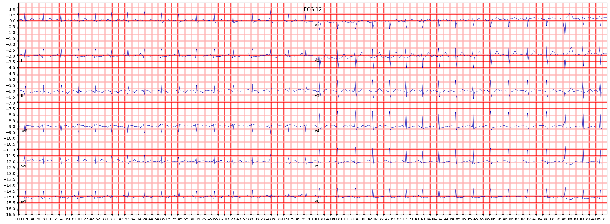 ischemic in inferolateral leads (ISCIL) example 1729