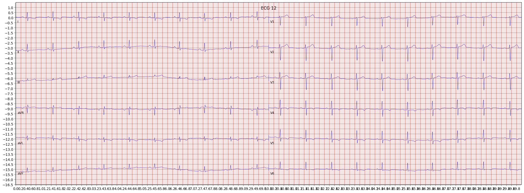 ischemic in anterolateral leads (ISCAL) example 1742