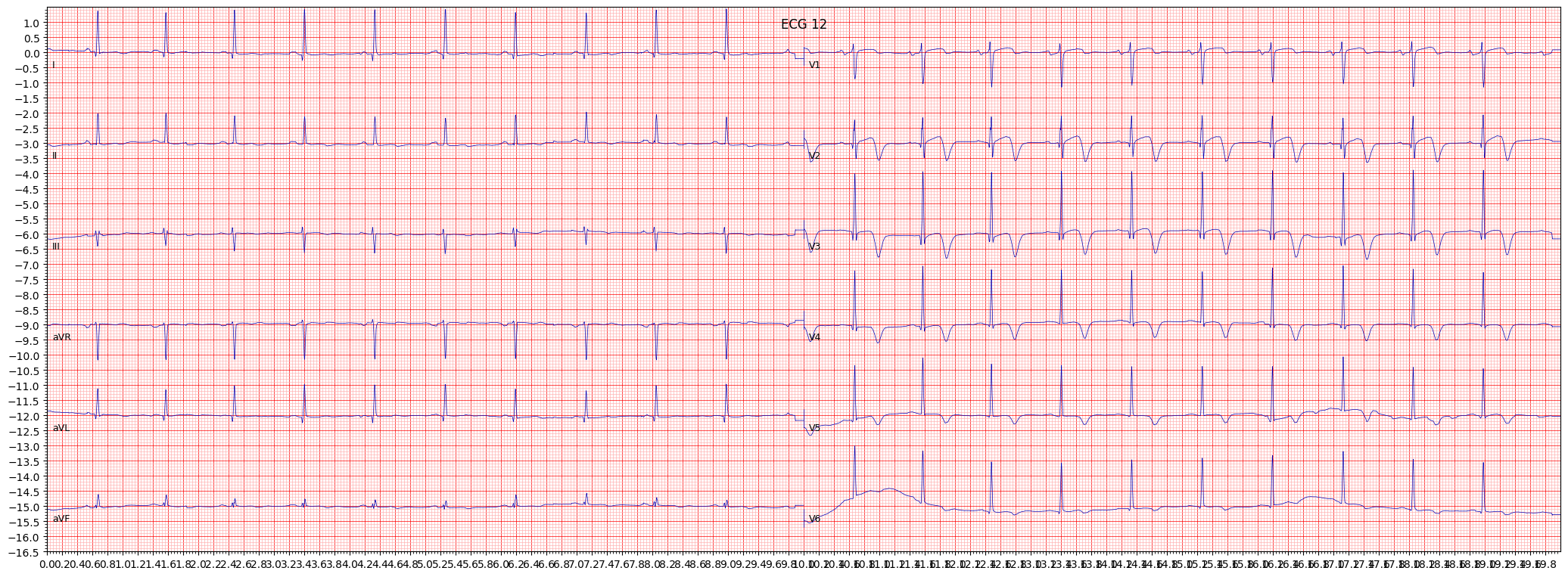 subendocardial injury in anteroseptal leads (INJAS) example 17993
