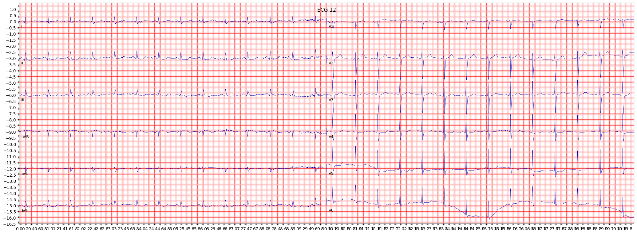 ischemic in lateral leads (ISCLA) example 18100