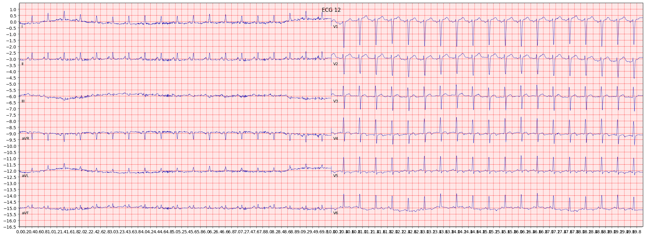 ischemic in lateral leads (ISCLA) example 18165
