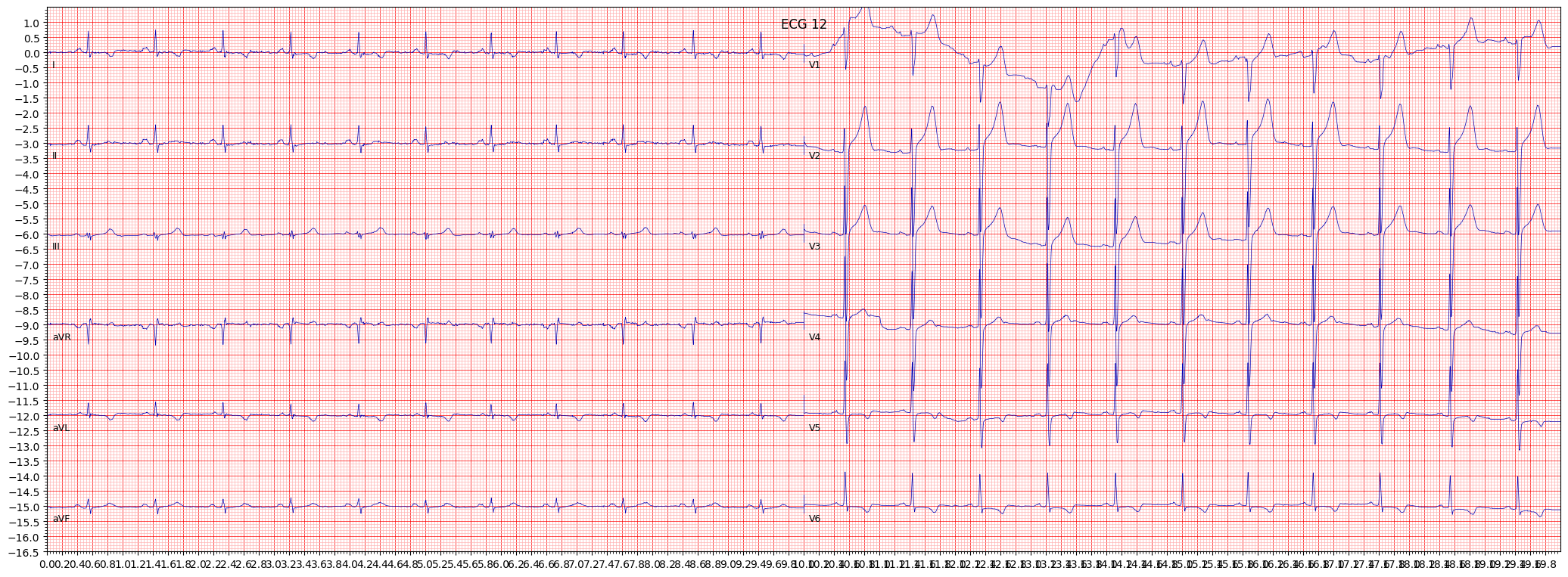 subendocardial injury in anterolateral leads (INJAL) example 18213