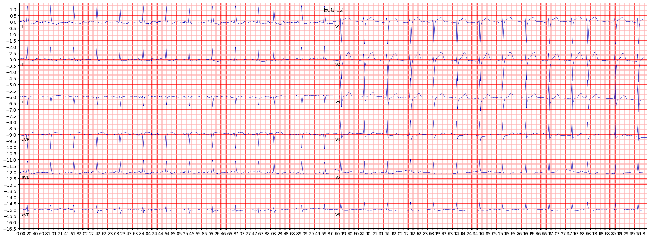 ischemic in anterolateral leads (ISCAL) example 1855