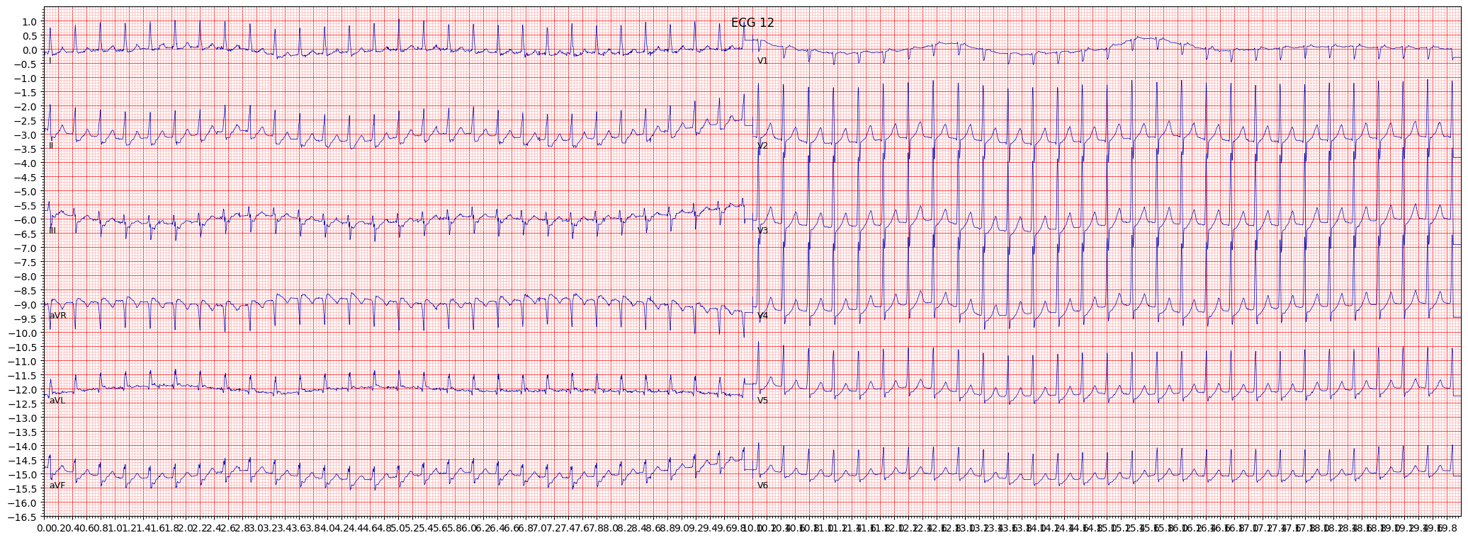 paroxysmal supraventricular tachycardia (PSVT) example 1919