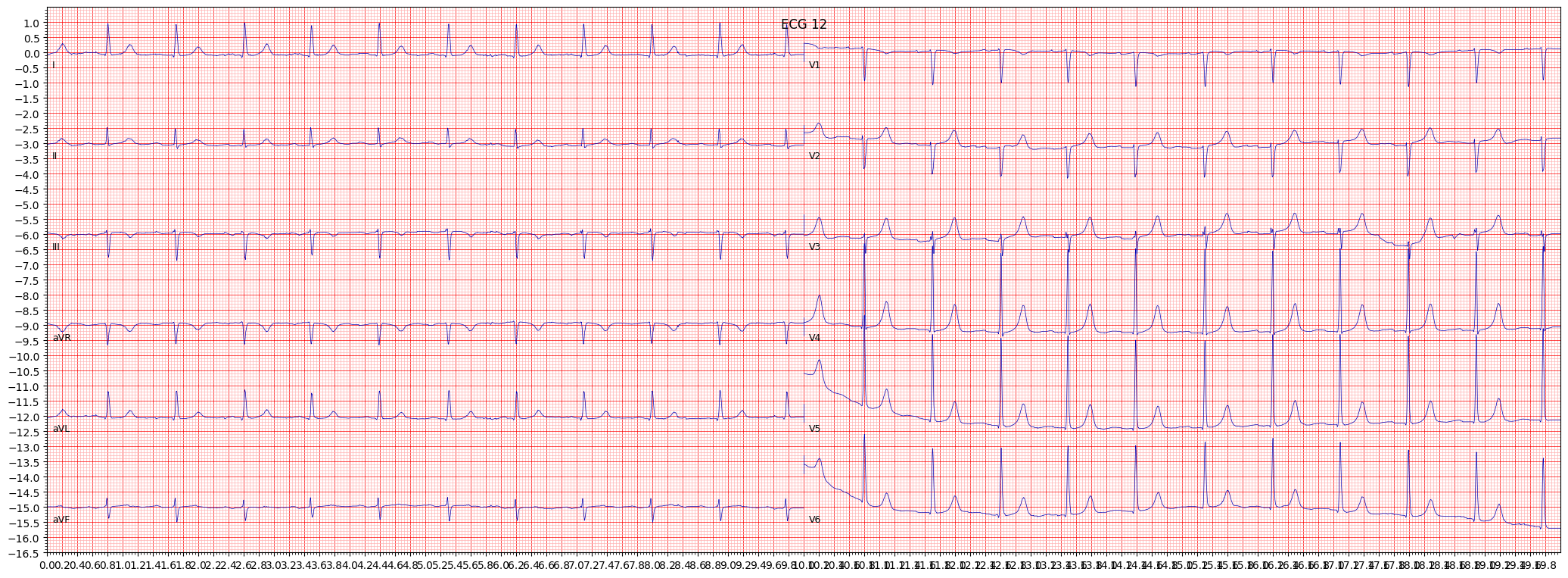 left ventricular hypertrophy (LVH) example 1996